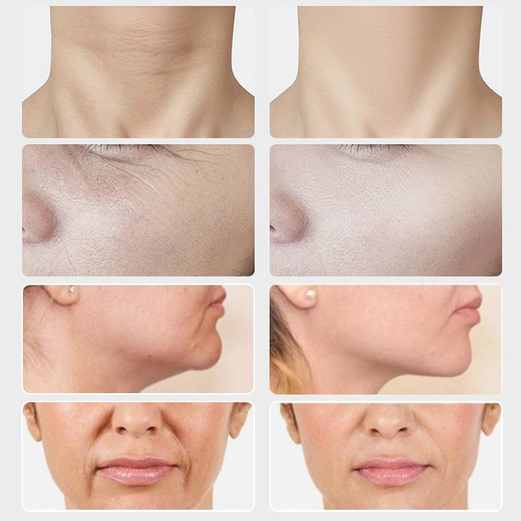 Skin Lifting & Firming Massage-Remove Wrinkle,V Face Therapy Beauty Device